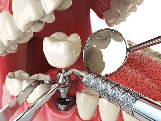 Best Emergency Root Canal Treatment in Conover, NC